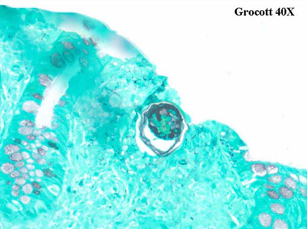 Grocott stain from lamina propria in the GI tract in a case of schistosomiasis