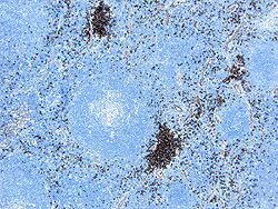 CD123 immunohistochemical stain, Castleman Disease