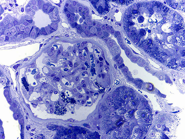 Toluidine-blue stained slide showing zebra bodies in a Fabry disease case