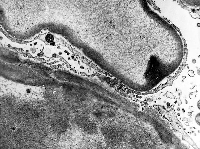 EM image of permeation of the glomerular basement membrane