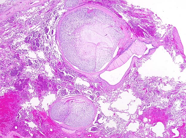 Extensive involvement of a neoplasm in pulmonary vessels