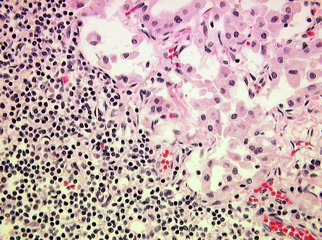 Hürthle cell hyperplasia in follicles