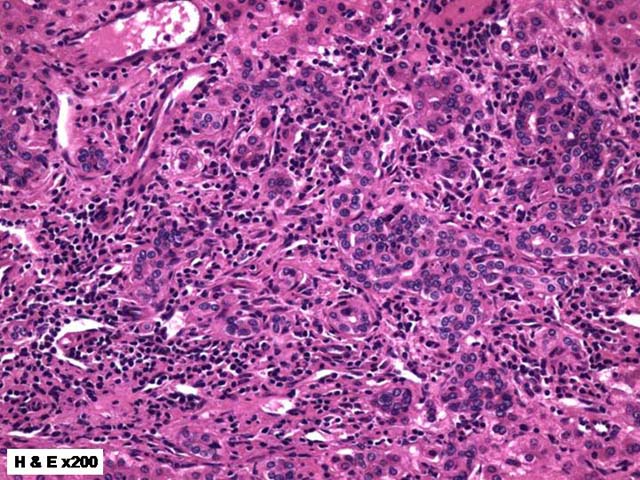 Lymphoplasmacytic inflammation in focal nodular hyperplasia lesions of the liver