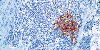 CK7 immunostain in a neuroendocrine carcinoma of the kidney case